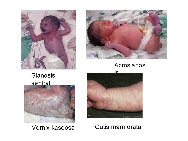 Sianosis sentral Vernix kaseosa Acrosianos is Cutis marmorata 