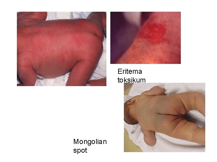 Eritema toksikum Mongolian spot 