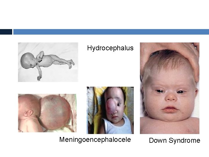 Hydrocephalus Meningoencephalocele Down Syndrome 