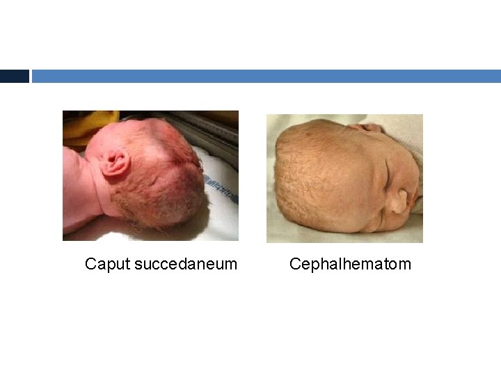 Caput succedaneum Cephalhematom 