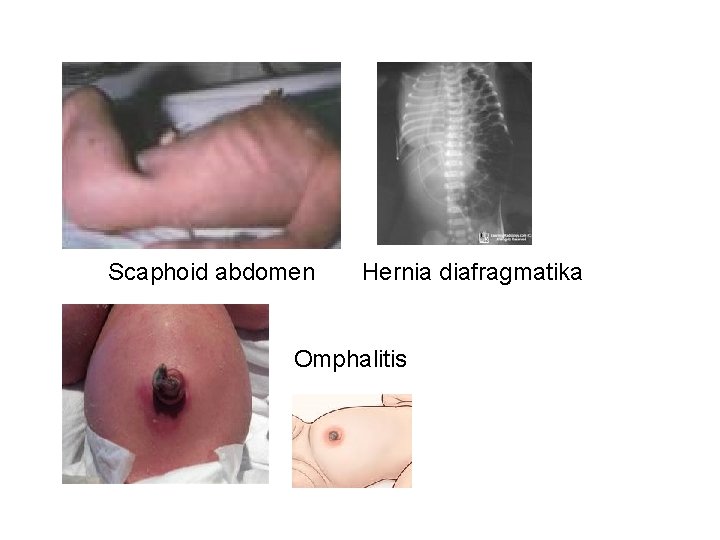 Scaphoid abdomen Hernia diafragmatika Omphalitis 