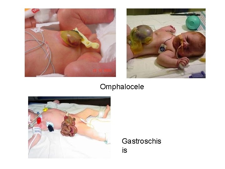 Omphalocele Gastroschis is 