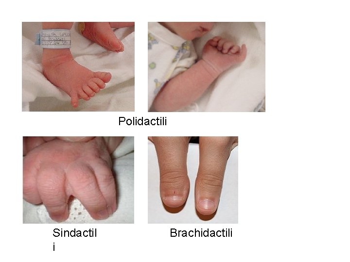 Polidactili Sindactil i Brachidactili 