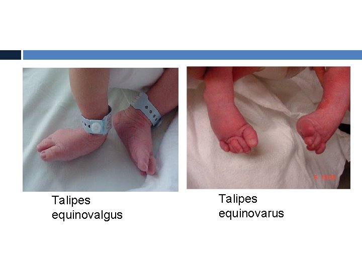 Talipes equinovalgus Talipes equinovarus 
