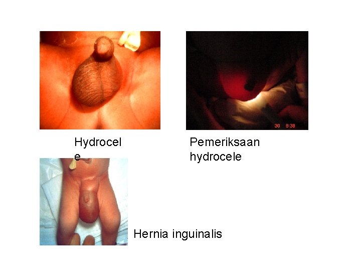 Hydrocel e Pemeriksaan hydrocele Hernia inguinalis 