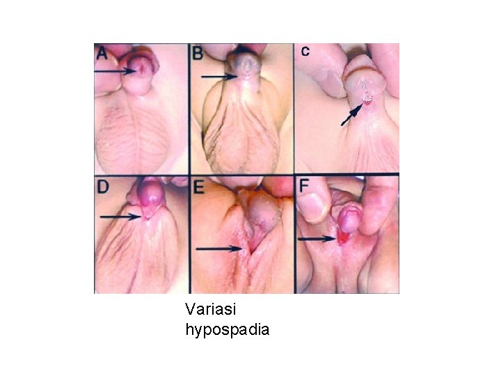 Variasi hypospadia 