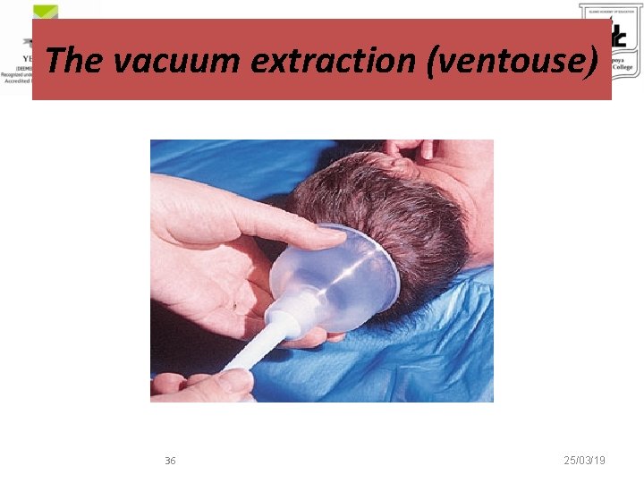 The vacuum extraction (ventouse) 36 25/03/19 