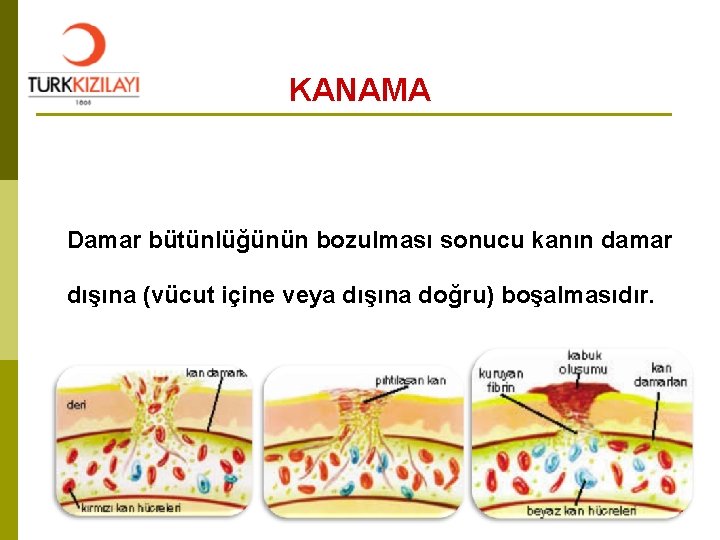 KANAMA Damar bütünlüğünün bozulması sonucu kanın damar dışına (vücut içine veya dışına doğru) boşalmasıdır.