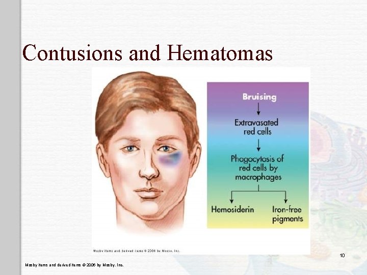 Contusions and Hematomas 10 Mosby items and derived items © 2006 by Mosby, Inc. Contusions and Hematomas 10 Mosby items and derived items © 2006 by Mosby, Inc.