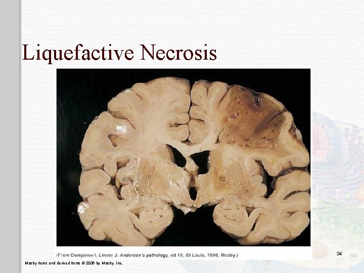 Liquefactive Necrosis 34 Mosby items and derived items © 2006 by Mosby, Inc. 