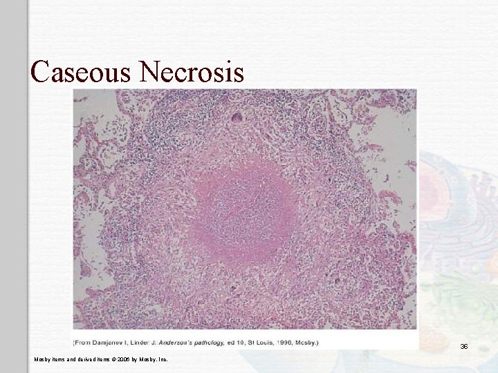 Caseous Necrosis 36 Mosby items and derived items © 2006 by Mosby, Inc. 