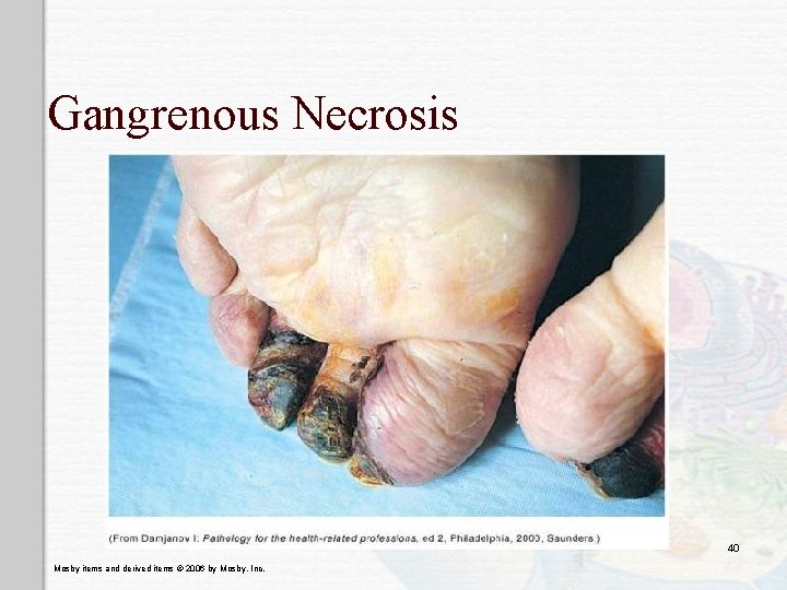 Gangrenous Necrosis 40 Mosby items and derived items © 2006 by Mosby, Inc. Gangrenous Necrosis 40 Mosby items and derived items © 2006 by Mosby, Inc.