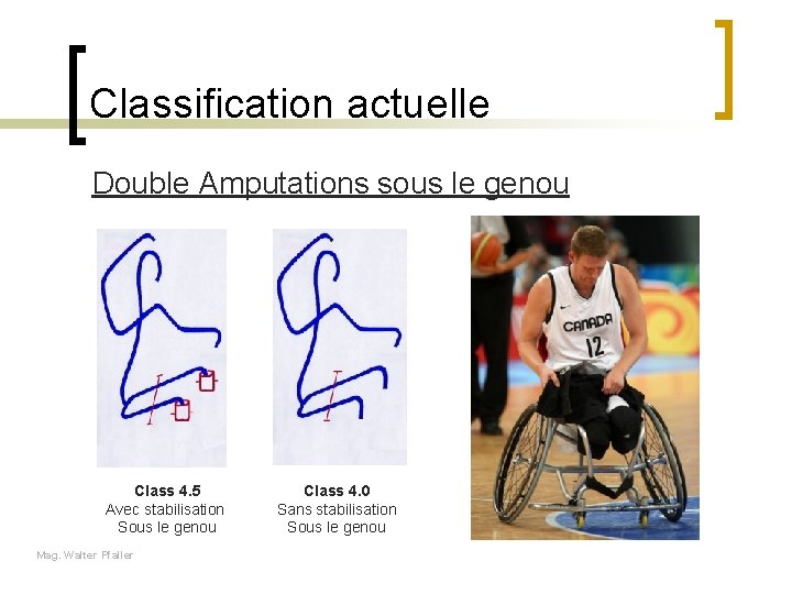 Classification actuelle Double Amputations sous le genou Class 4. 5 Avec stabilisation Sous le
