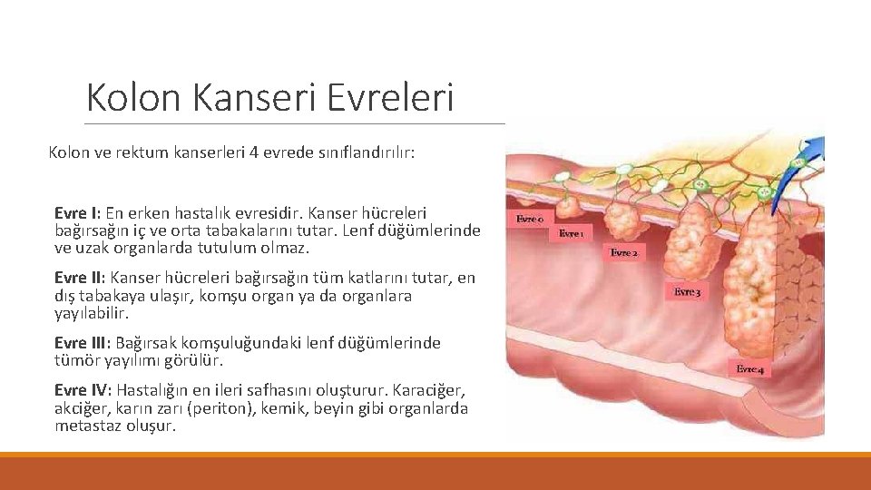 Kolon Kanseri Evreleri Kolon ve rektum kanserleri 4 evrede sınıflandırılır: Evre I: En erken