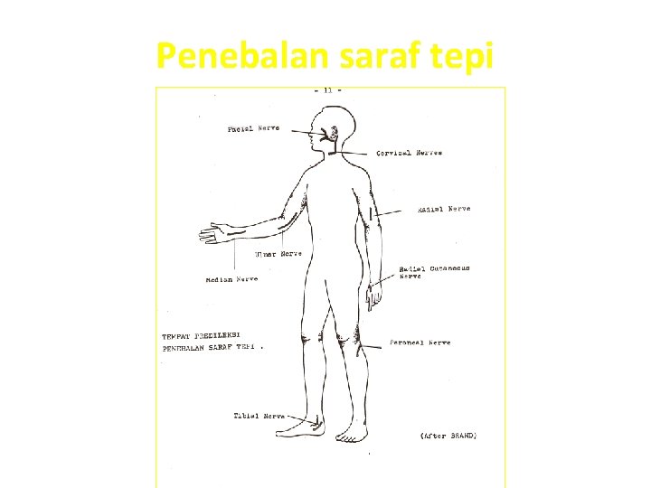 Penebalan saraf tepi 