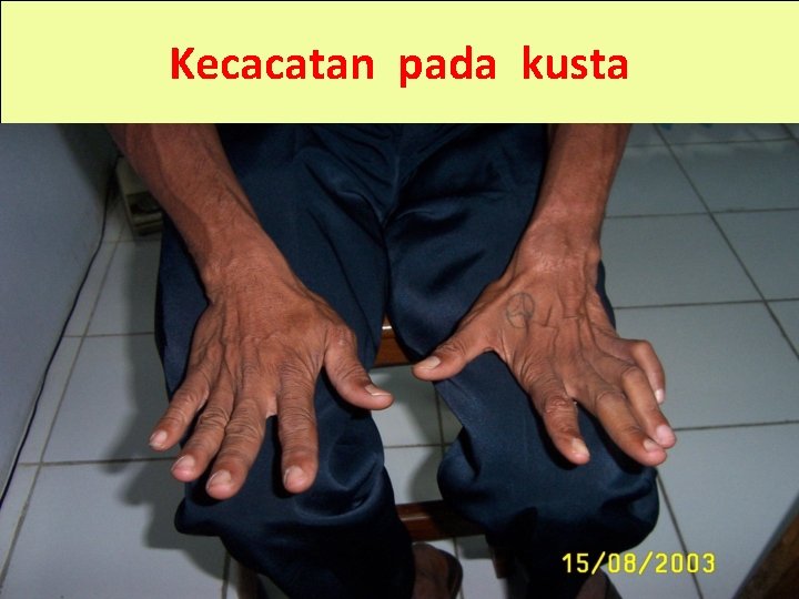 Kecacatan pada kusta 