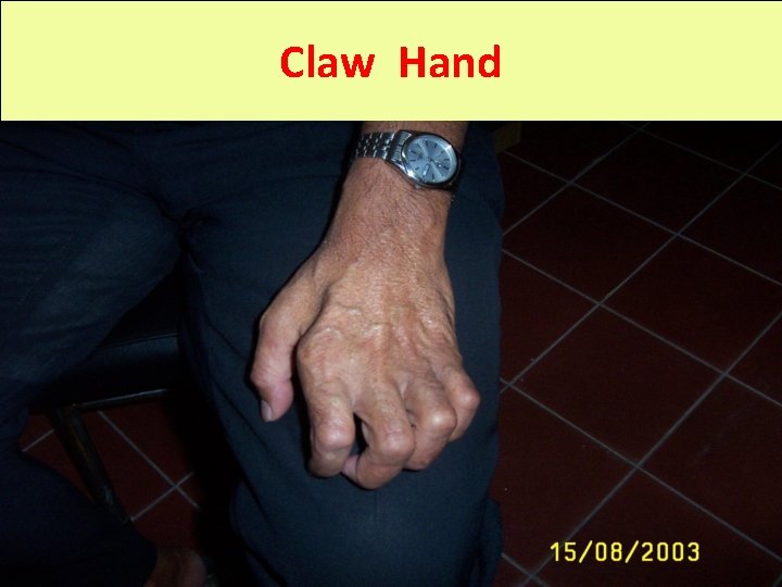 Claw Hand 