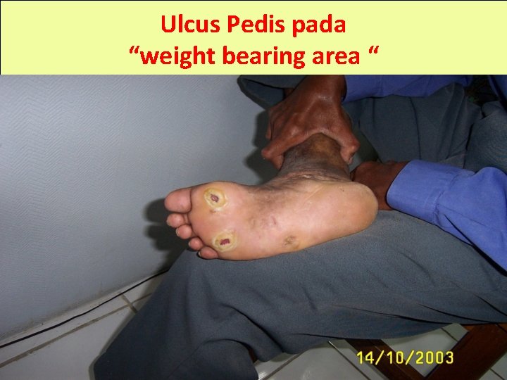 Ulcus Pedis pada “weight bearing area “ 