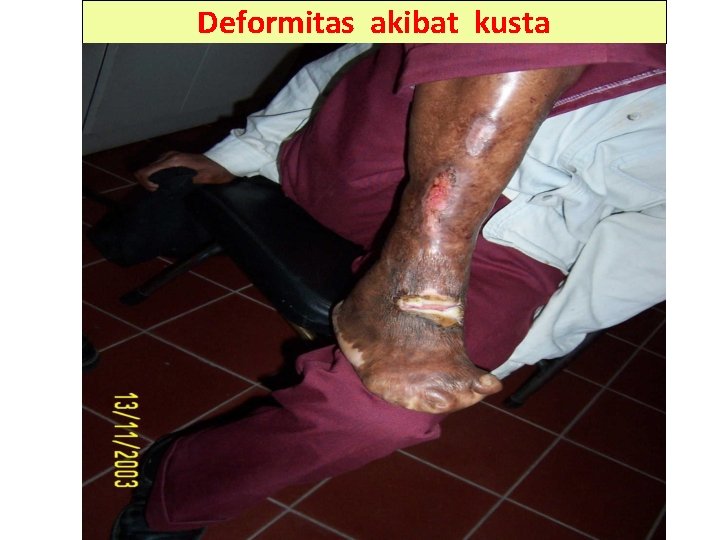 Deformitas akibat kusta 