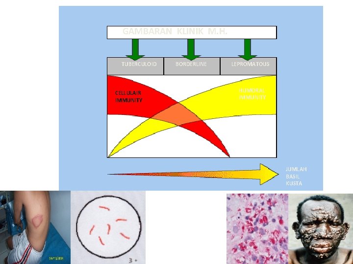 GAMBARAN KLINIK M. H. TUBERCULOID CELLULAIR IMMUNITY BORDERLINE LEPROMATOUS HUMORAL IMMUNITY JUMLAH BASIL KUSTA