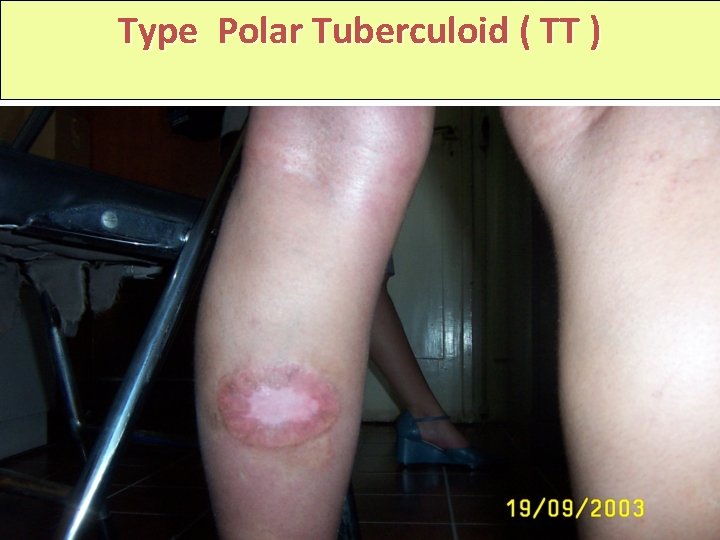 Type Polar Tuberculoid ( TT ) 