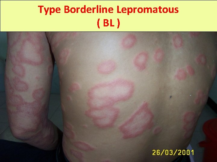 Type Borderline Lepromatous ( BL ) 