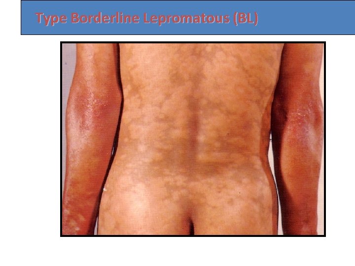 Type Borderline Lepromatous (BL) 