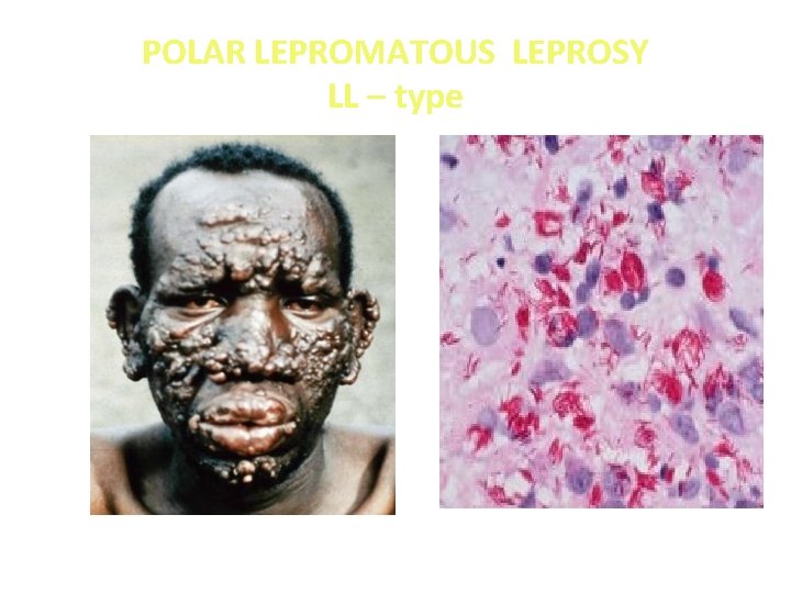 POLAR LEPROMATOUS LEPROSY LL – type 