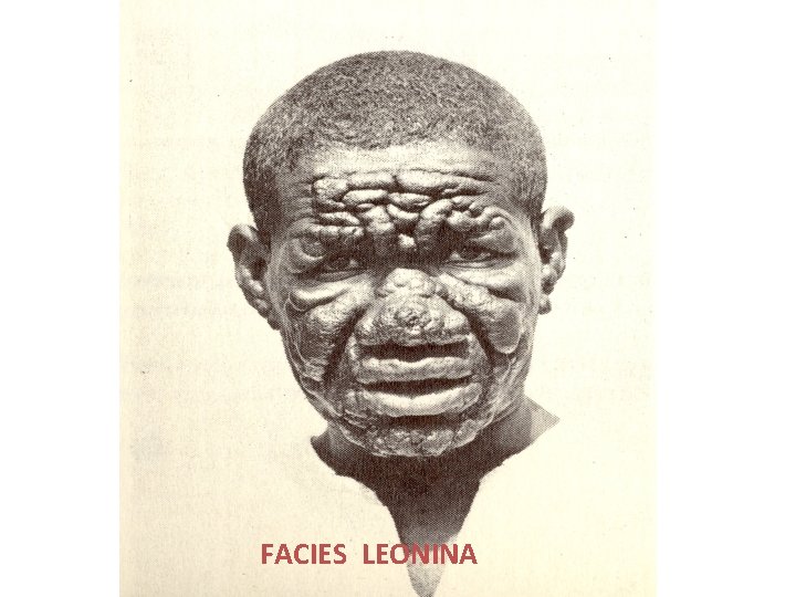 FACIES LEONINA 