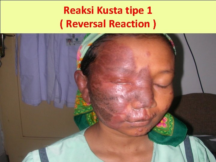 Reaksi Kusta tipe 1 ( Reversal Reaction ) 