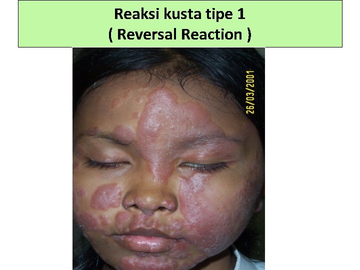 Reaksi kusta tipe 1 ( Reversal Reaction ) 
