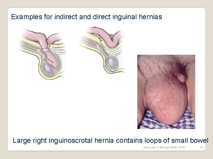 Examples for indirect and direct inguinal hernias Large right inguinoscrotal hernia contains loops of