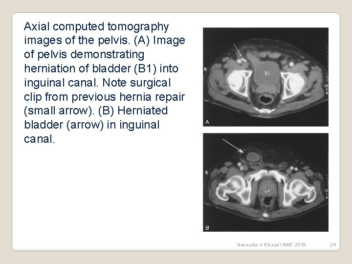 Axial computed tomography images of the pelvis. (A) Image of pelvis demonstrating herniation of