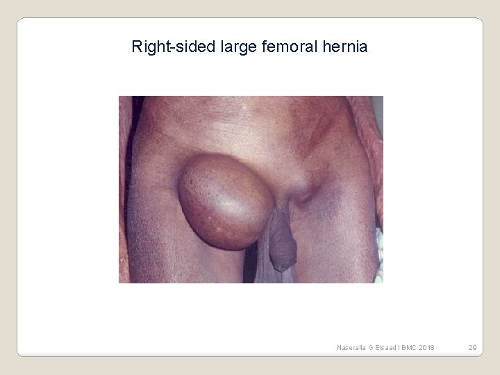 Right-sided large femoral hernia Naseralla G Elsaad l BMC 2018 29 