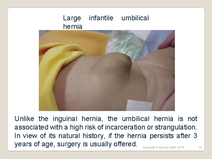 Large infantile hernia umbilical Unlike the inguinal hernia, the umbilical hernia is not associated