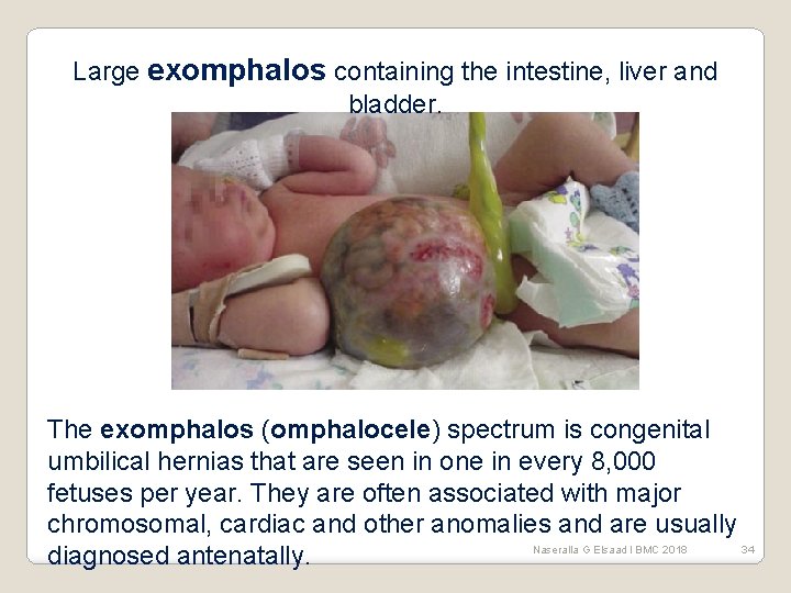 Large exomphalos containing the intestine, liver and bladder. The exomphalos (omphalocele) spectrum is congenital