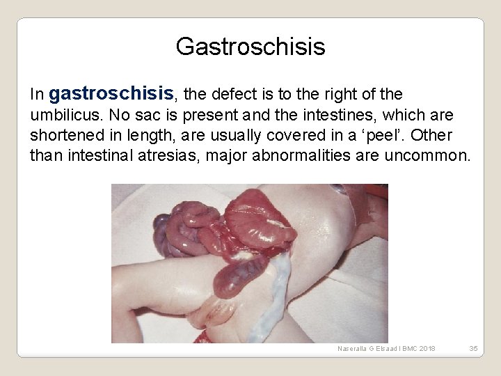 Gastroschisis In gastroschisis, the defect is to the right of the umbilicus. No sac