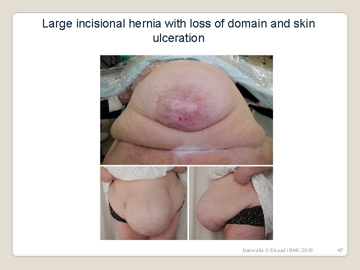 Large incisional hernia with loss of domain and skin ulceration Naseralla G Elsaad l