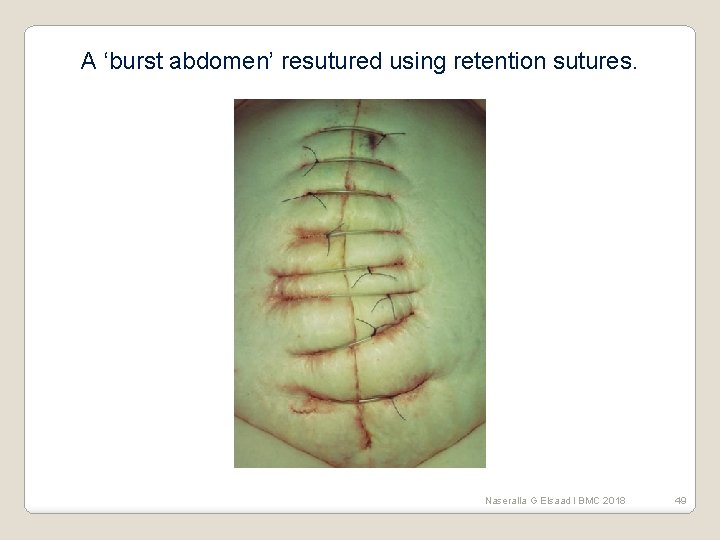 A ‘burst abdomen’ resutured using retention sutures. Naseralla G Elsaad l BMC 2018 49