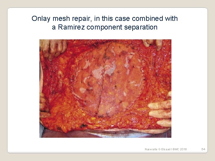 Onlay mesh repair, in this case combined with a Ramirez component separation Naseralla G