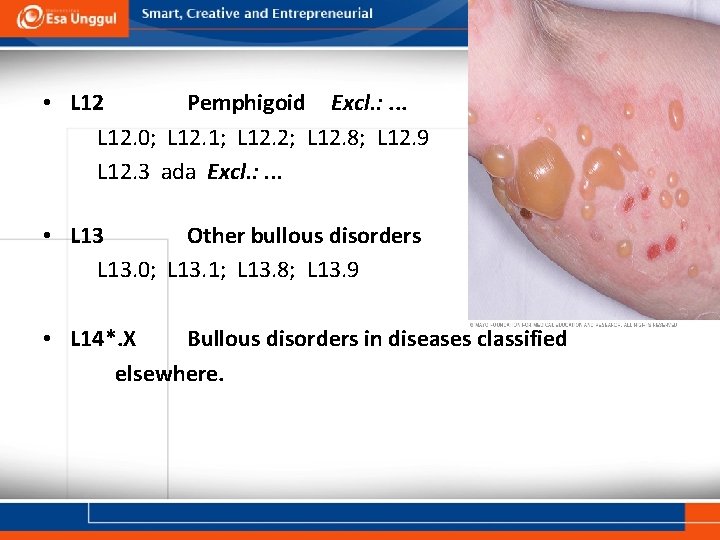  • L 12 Pemphigoid Excl. : . . . L 12. 0; L