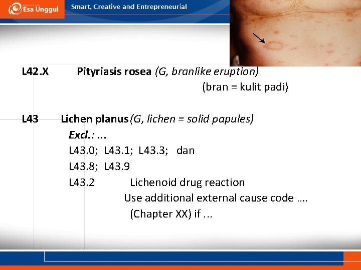 L 42. X L 43 Pityriasis rosea (G, branlike eruption) (bran = kulit padi)