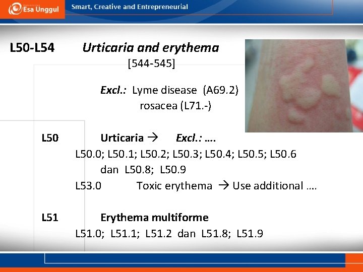 L 50 -L 54 Urticaria and erythema [544 -545] Excl. : Lyme disease (A