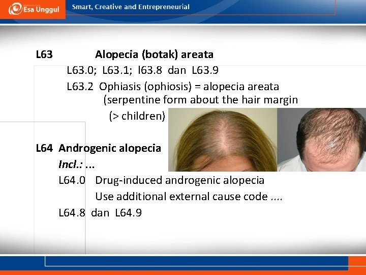 L 63 Alopecia (botak) areata L 63. 0; L 63. 1; l 63. 8