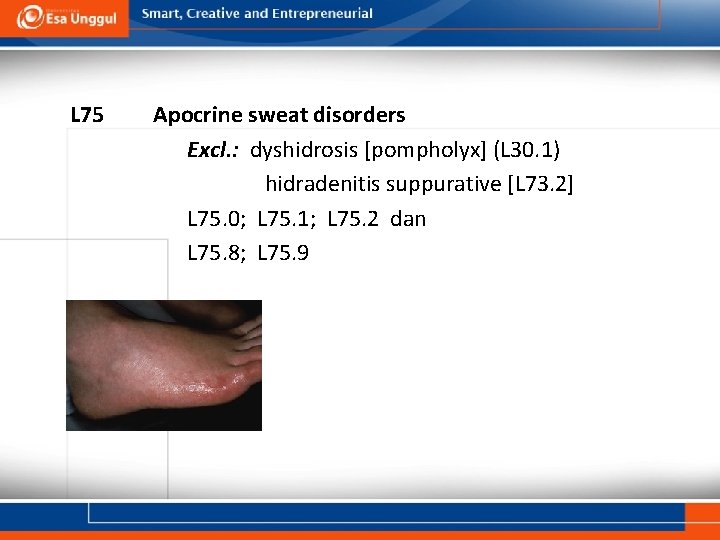 L 75 Apocrine sweat disorders Excl. : dyshidrosis [pompholyx] (L 30. 1) hidradenitis suppurative