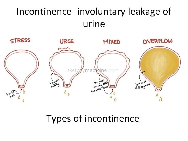 Incontinence- involuntary leakage of urine Types of incontinence 