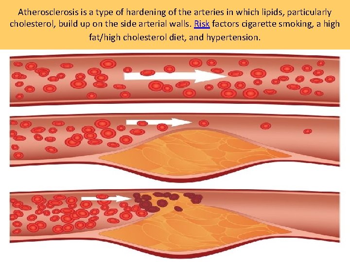 Atherosclerosis is a type of hardening of the arteries in which lipids, particularly cholesterol,