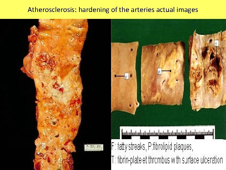 Atherosclerosis: hardening of the arteries actual images 