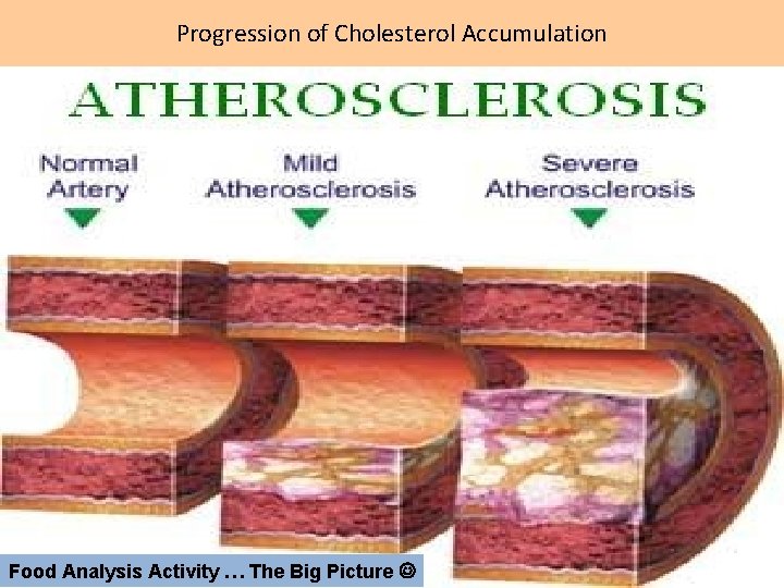 Progression of Cholesterol Accumulation Food Analysis Activity … The Big Picture 