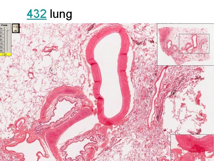 432 lung 